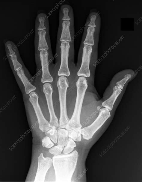 Normal Hand X Ray Stock Image C0393288 Science Photo Library