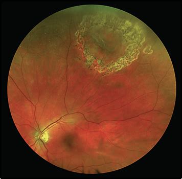 The longer retinal detachment goes untreated, the greater your risk of permanent vision. Retinal Physician - Retinal Breaks: Clinical Course and ...
