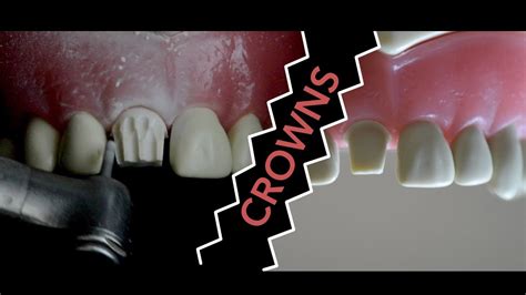 Dental Crown Procedure Youtube