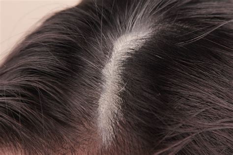 How To Clean Sebum From The Scalp Livestrongcom