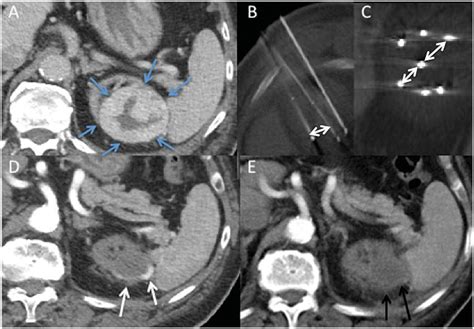 Axial Contrast Enhanced Computed Tomography Ct Images A T1b Renal