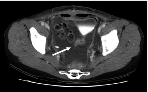 Ascites Computed Tomography Shows Abundant Ascites In Abdominal Cavity