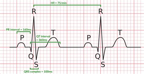 Normal Qrs Time