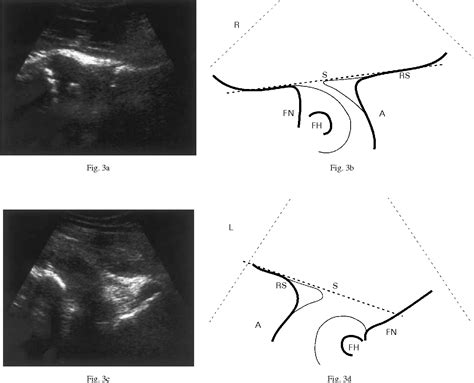 Figure 3 From Ultrasound In The Management Of The Position Of The Femoral Head During Treatment