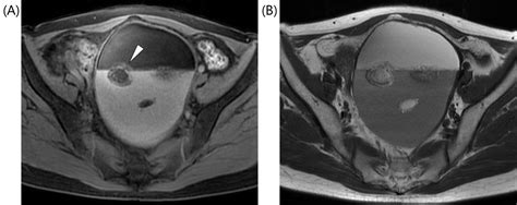 Cureus A Rare Urothelial Malignant Transformation In A Mature Cystic