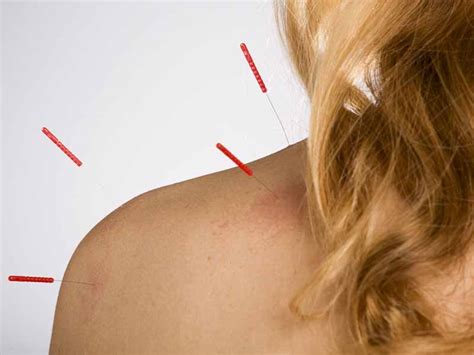 Research Finds Acupuncture Effective For Chronic Pain Aafp