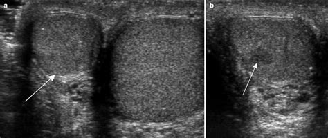 Testicular Cancer Imaging Radiology Key