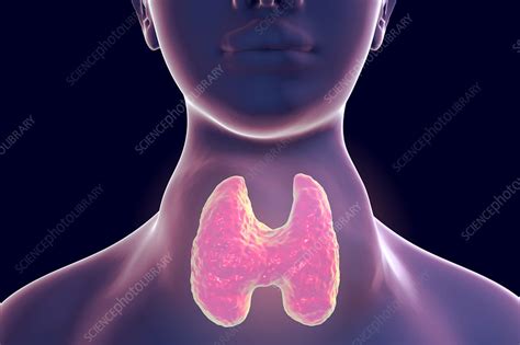 Thyroid Goitre Illustration Stock Image F0209974 Science Photo