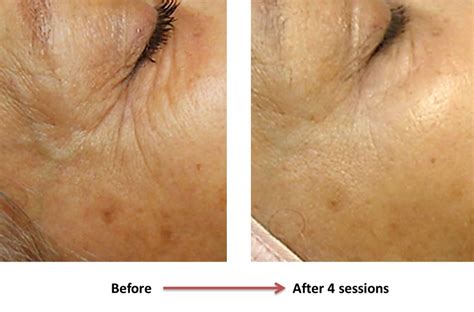 Laser Eye Wrinkle Reduction Canadian Optic And Laser Rejuvenation