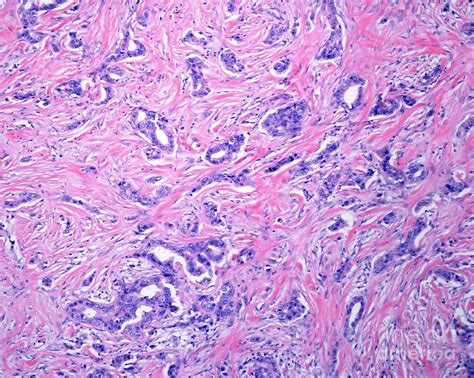 Invasive Carcinoma Of The Breast Photograph By Jose Calvoscience Photo