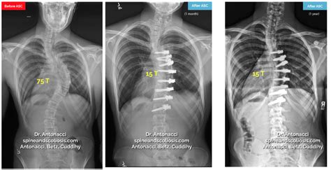 Before And After Asc Scoliosis Surgery