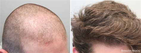 The available data suggest that dutasteride 0.5 mg po once daily is at least as effective as 1 mg/day of finasteride in hair growth improvement. propecia vs rogaine