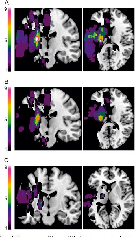 Figure 1 From Identifying Neuroimaging Markers Of Motor Disability In