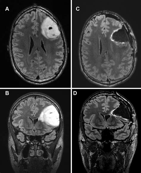 Brain Cancer Glioblastoma Stage 4 Inoperable Brain Tumor Cancer