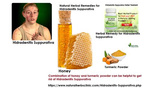Make Use Of Given 10 Natural Remedies For Hidradenitis Suppurativa