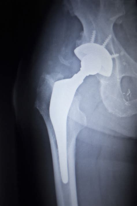 Metal On Metal Hip Implant Lawsuit Calls Depuy Pinnacle Defective Top