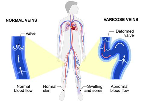 Why Varicose Veins Occur Mybeautygym