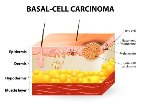 Basal Cell Carcinomarodent Ulcers