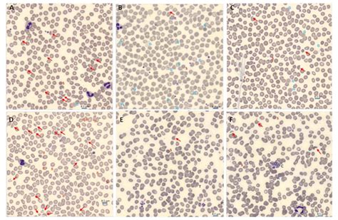 Blood Smear Abnormalities In Covid 19 Morphology Evaluation Of