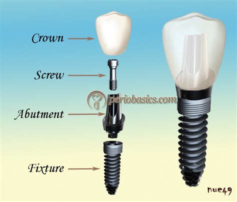 Dental Implant Components And Current Concepts In Implant Design Implantology
