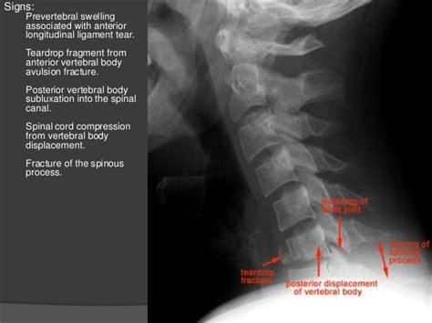 Cervical Spine Fractures Muhamma