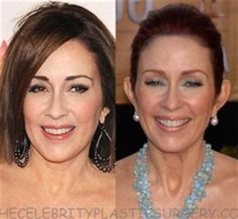 Best Patricia Heaton Plastic Surgery Before And After Ideas