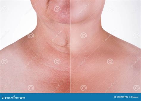 Skin Rejuvenation On The Neck Before After Anti Aging Concept Wrinkle