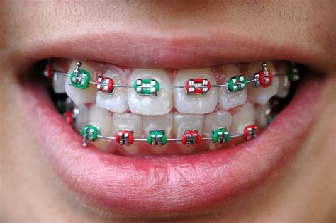 Orthodontic Alloys What Braces Are Made Of Orthodontics In London