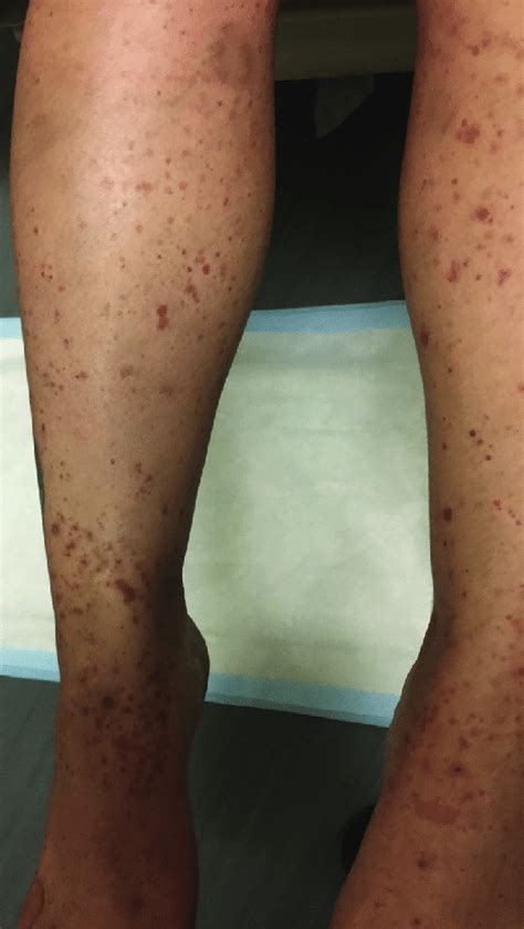 Purpuric Macules And Papules Overlying The Lower Extremities Bilaterally Download Scientific