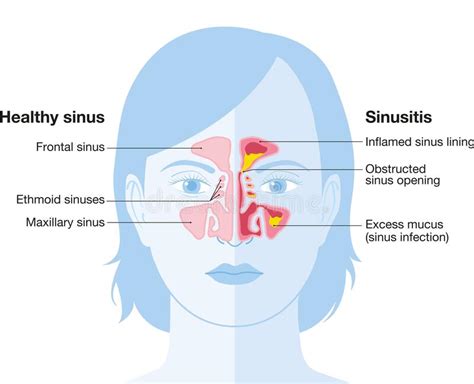 Sinusitis Vector Illustration1 Stock Illustration Illustration Of