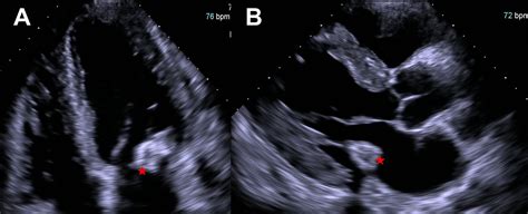 Cureus Caseous Calcifications Of Mitral Annulus As An Unusual Cause