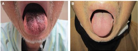 Hyperpigmentation On The Dorsal Tongue European Journal Of Internal