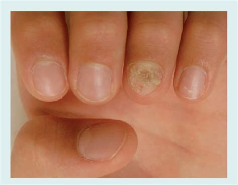 Nail Psoriasis Of The Fourth Left Fingernail In A 5 Year Old Girl