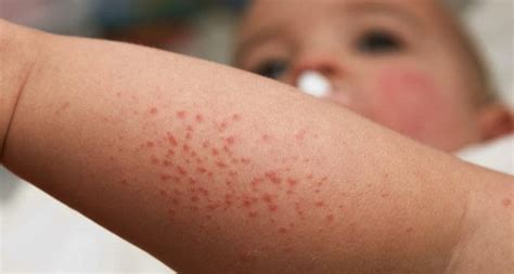 Flea Bites On Babies Face