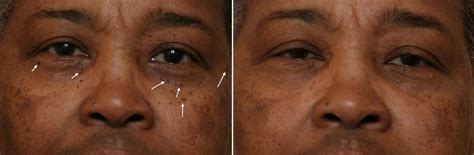 African American And Ethnic Skin Dermatology Black Dermatologist