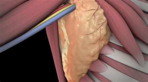 A 3d Computer Animation Of The Axillary Lymph Node Dissection Alnd