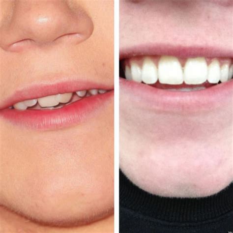 Patients requiring braces have different type of problems with different kind of intensity of the problem. One Direction's Niall Horan Shows Off His New Smile After ...