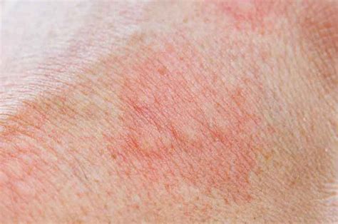 7 Home Remedies For Dermatitis