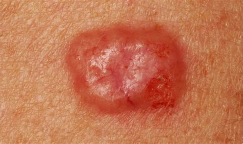 Basal Cell Carcinoma A Highly Curable Cancer If Treated Early