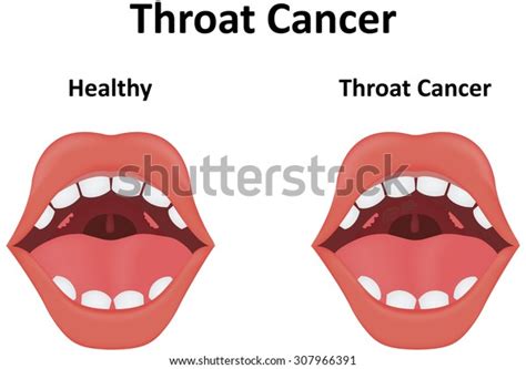 What Doesthroat Cancer Look Like Throat Cancer Surgery Mediglobus
