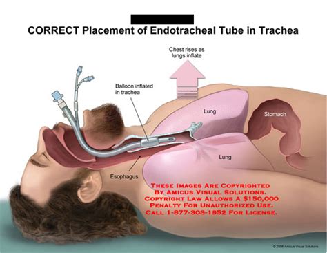 Correct Placement Of Endotracheal Tube In Trachea