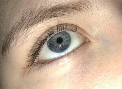 White Spots Under Eyes Little Not Milia Pictures Cholesterol