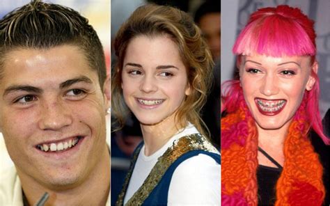 Brace Yourself Here Are Celebs Who Owe Their Million Dollar Smiles To Braces Luxurylaunches