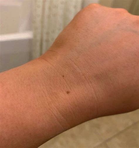 Viral ‘freckle On Wrist Challengel Do You Have One