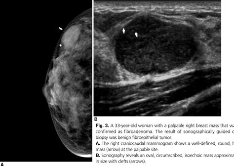 Figure 1 From Phyllodes Tumors And Fibroepithelial Lesions With