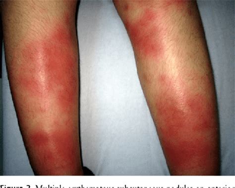 Figure 2 From Erythema Multiforme And Erythema Nodosum Lesions With