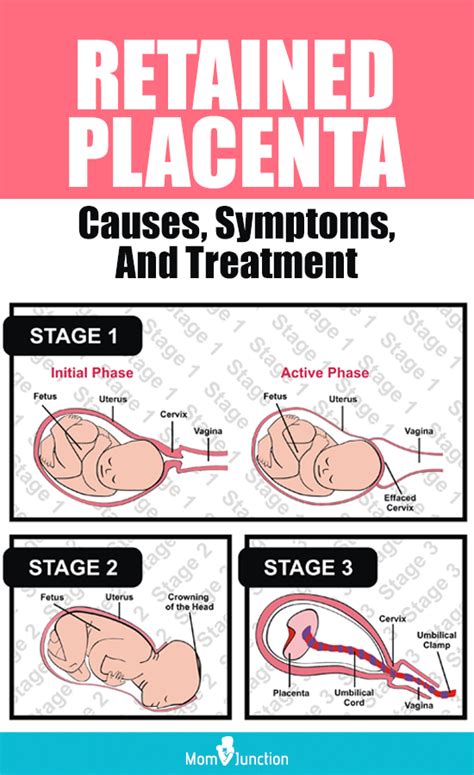 Retained Placenta Causes Symptoms And Treatment