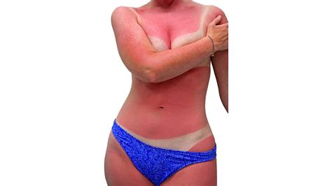 Can A Sunburn Cause Skin Cancer Howcast