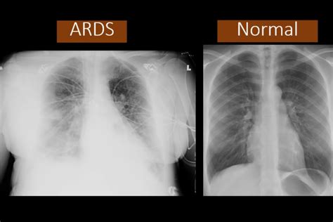 The lung abnormalities extended from the periphery to the central giving a diffuse pattern in 25%. For Recruits, COVID-19 Is Just Another Preexisting ...