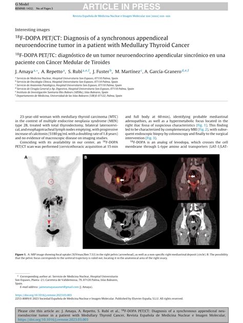 Pdf 18f Dopa Petct Diagnosis Of A Synchronous Appendiceal